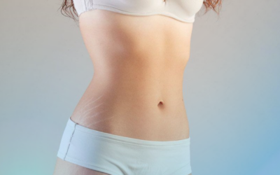 ¿Cómo Corregir Las Estrías Y Flacidez?