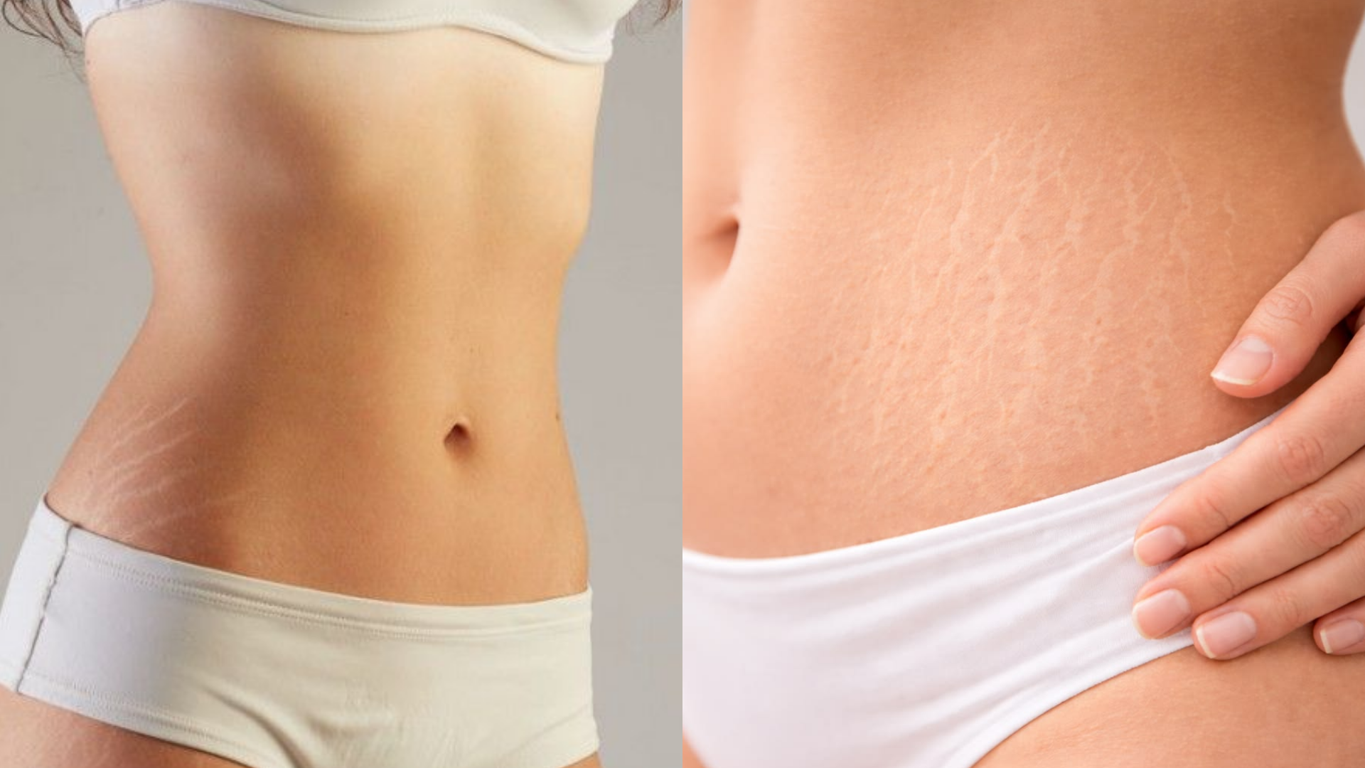 Especialista en estética avanzada tratando estrías en nuestro centro de Barcelona