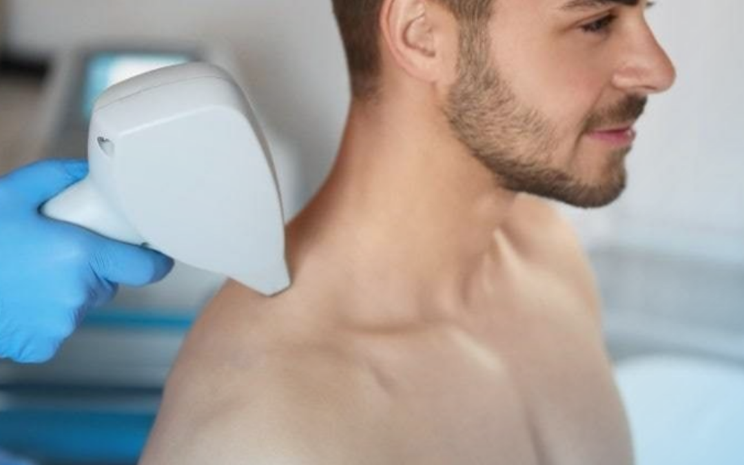 Depilación láser masculina